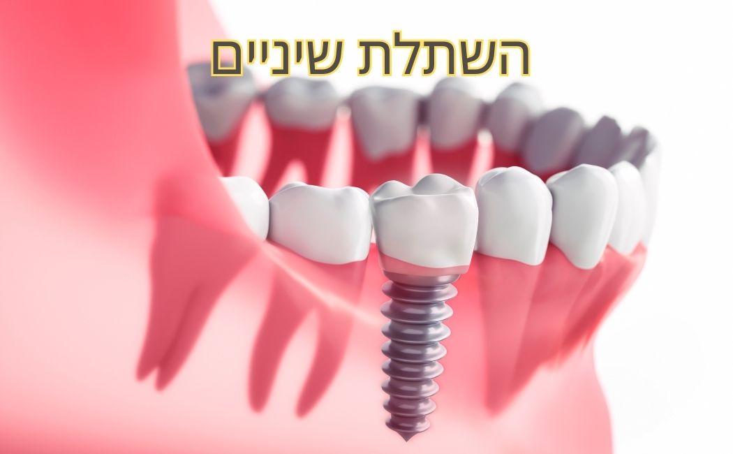 השתלת שיניים לשיקום הפה